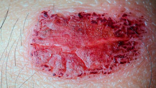 El melanoma no es el único cáncer de piel grave El melanoma no es el único cáncer de piel grave
