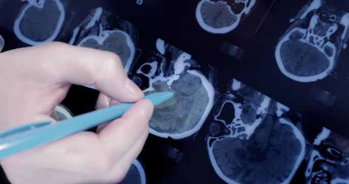 Surge una novedosa teoría sobre el mal de Parkinson