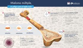 Mieloma múltiple, un peligro para el tejido