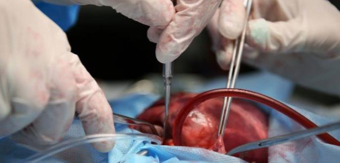 Causas de mortalidad precoz en trasplante cardíaco