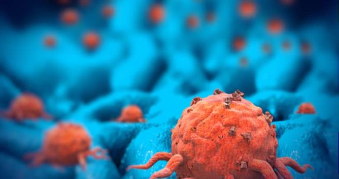El trasplante fecal puede aumentar la supervivencia en pacientes con cáncer de páncreas