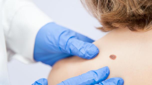 Tratamiento permite que el 52% de pacientes con melanoma avanzado sobreviva al menos 5 años