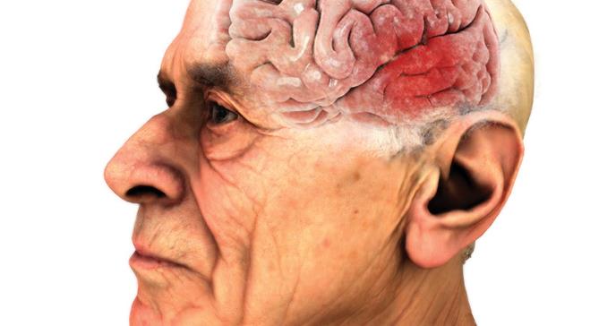 Tratamientos quirúrgicos y no quirúrgicos en el manejo de la enfermedad de Parkinson