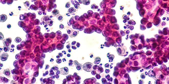 Identifican proteína del sistema inmunitario que favorece la progresión de tumores Identifican proteína del sistema inmunitario que favorece la progresión de tumores