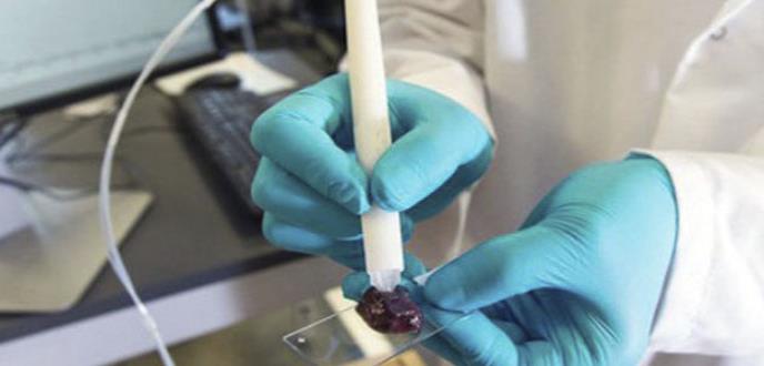 Un dispositivo identifica el cáncer en segundos y con precisión durante la cirugía