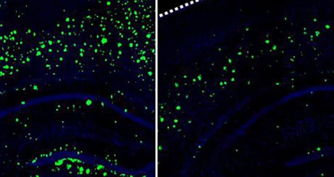 Proteína artificial lograría evitar la aparición del alzhéimer