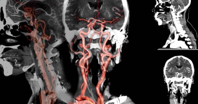 Un fármaco utilizado contra el cáncer podría ser eficaz para tratar aneurismas cerebrales