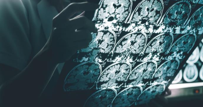 Un medicamento contra el VIH podría servir para tratar el Alzheimer