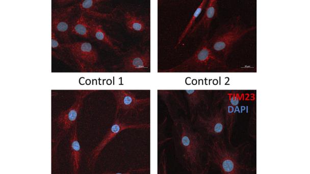 Una anomalía genética, clave para el desarrollo de nuevas terapias contra la diabetes Una anomalía genética, clave para el desarrollo de nuevas terapias contra la diabetes