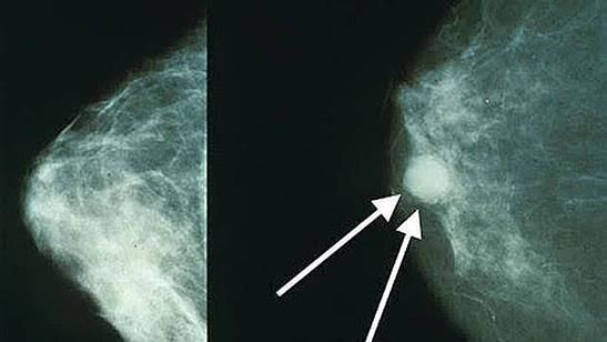 Una prueba permite saber precozmente si el cáncer de mama responderá a la quimioterapia Una prueba permite saber precozmente si el cáncer de mama responderá a la quimioterapia