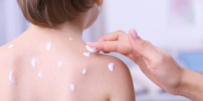 México revela sus estadísticas de varicela y herpes zóster México revela sus estadísticas de varicela y herpes zóster