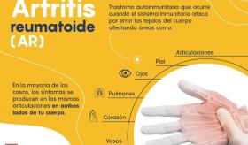 Artritis Reumatoide