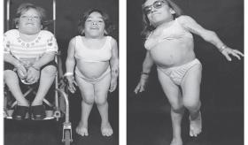 Promueven la conciencia del síndrome de morquio