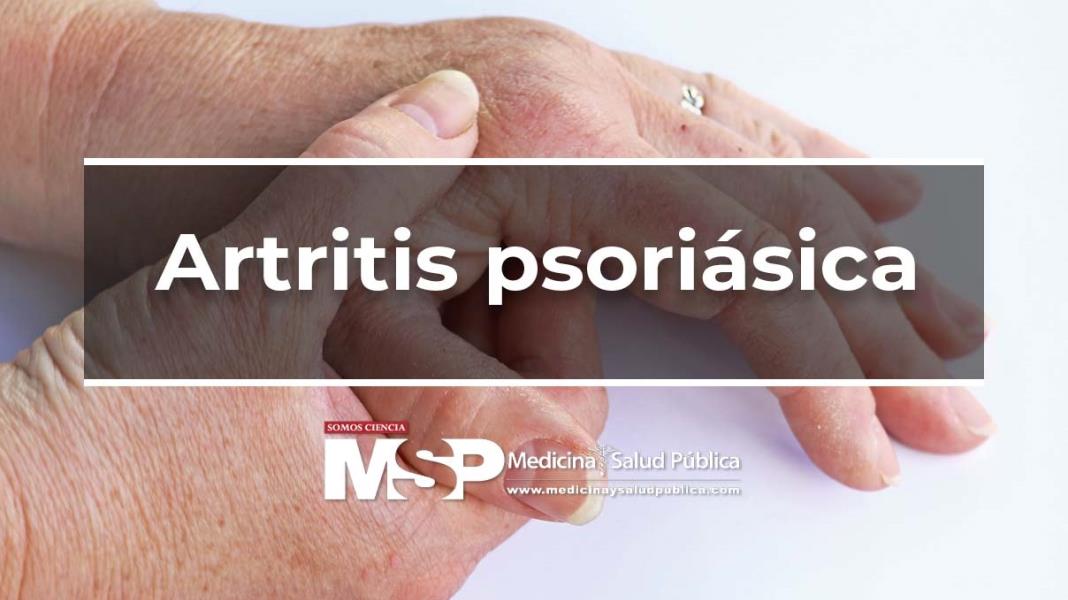 Artritis psoriásica