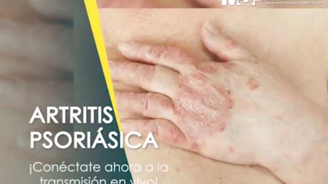 Artritis psoriásica