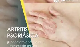 Artritis psori&aacute;sica