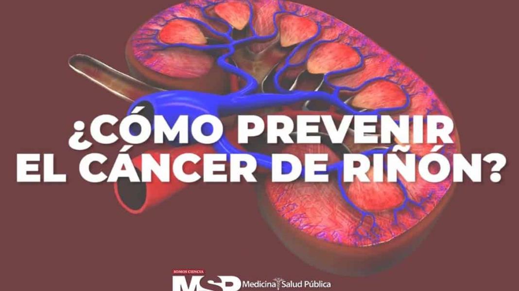 ¿Cómo prevenir el cáncer de riñón?