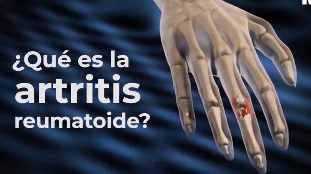 ¿Qué es la artritis reumatoide?