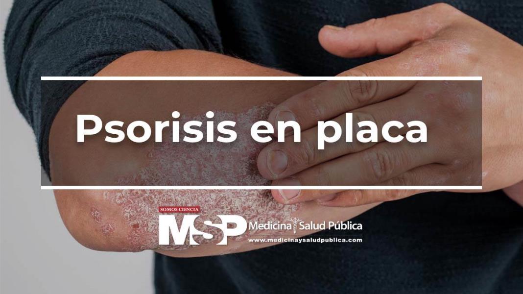 Psoriasis en Placa