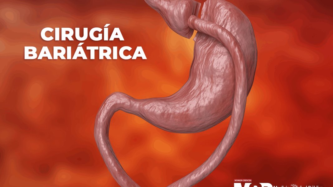 Cirugía bariátrica