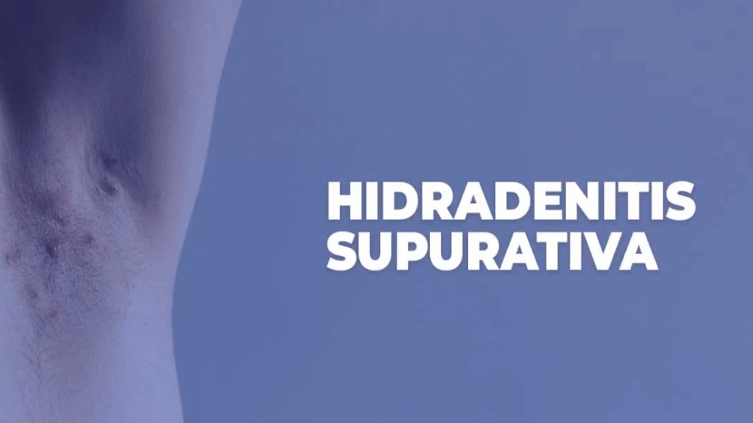 Actualización clínica sobre hidradenitis en Puerto Rico
