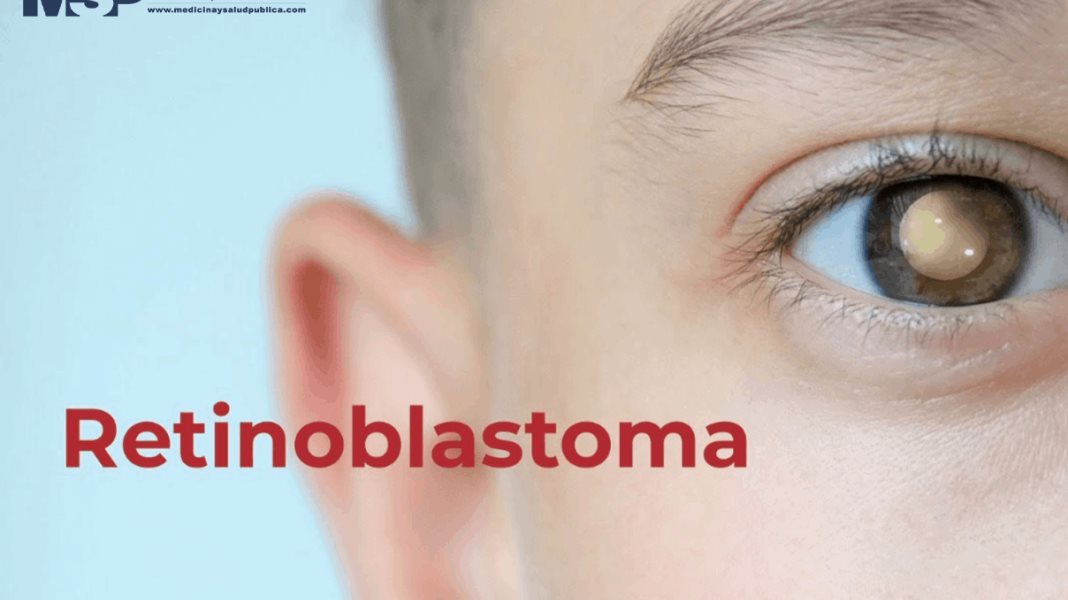 Retinoblastoma