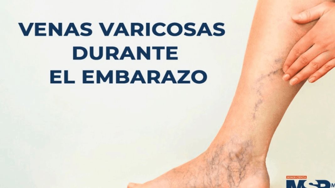 Venas varicosas durante el embarazo