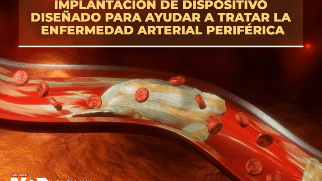 Implantación de dispositivo diseñado para ayudar a tratar la enfermedad arterial periférica