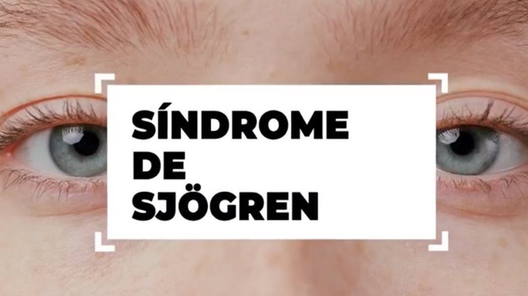 Síndrome de sjogren