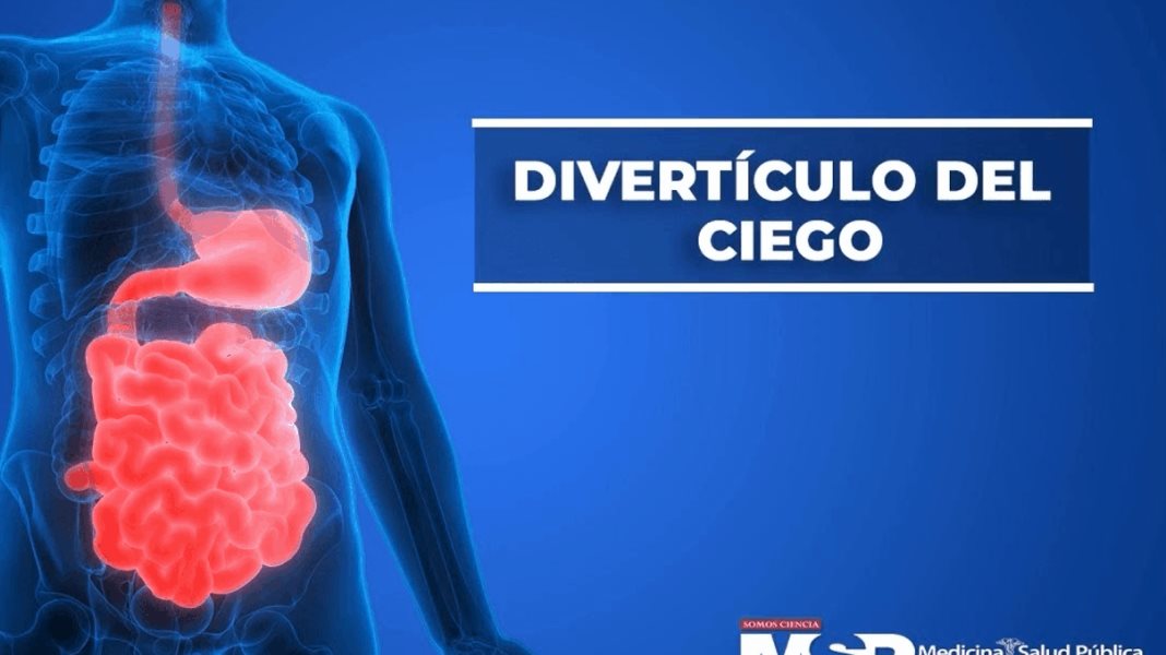 Divertículo del ciego