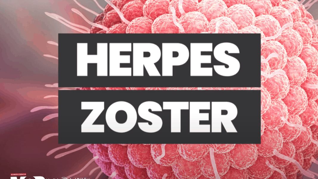 Herpes zoster