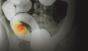 El alimento habitual que aumenta el riesgo de cáncer de colon, según nutricionista