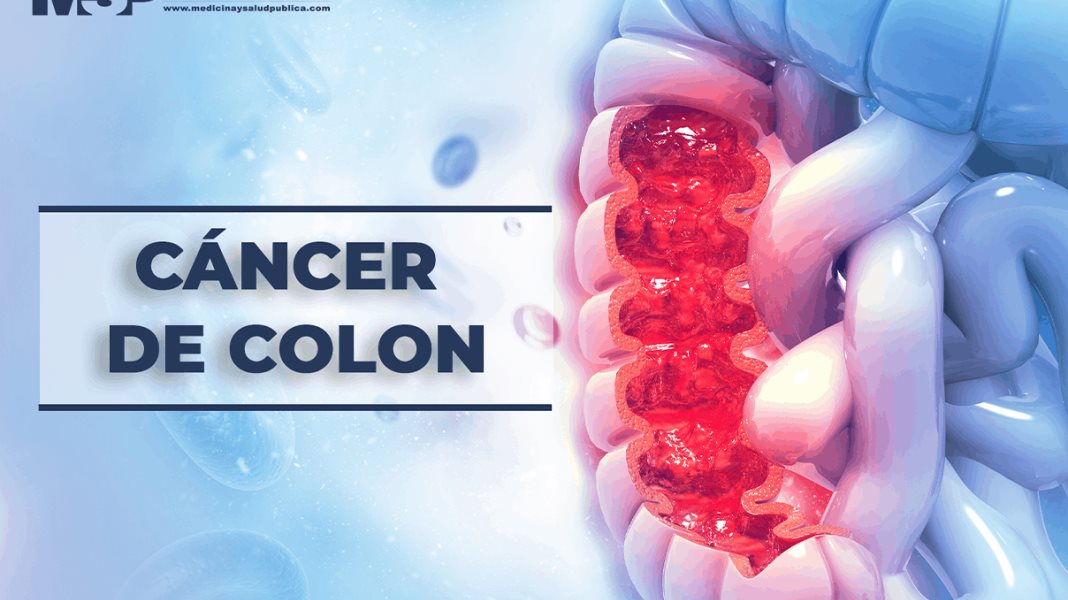 Cáncer de colon