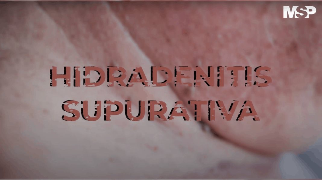 Hidradenitis Supurativa