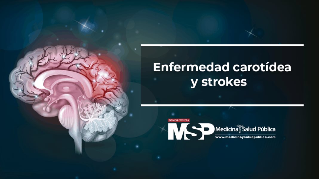 Enfermedad Carotídea y strokes