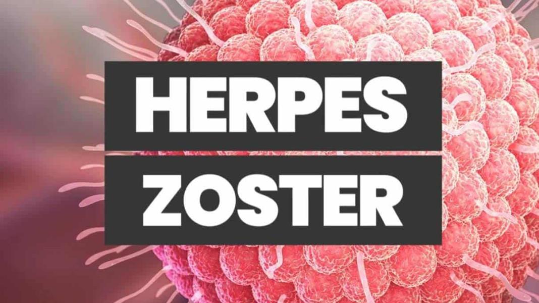 Herpes zoster