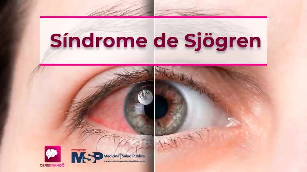 Síndrome de Sjögrens