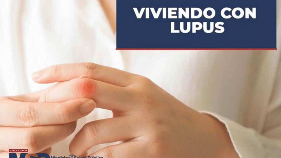 Viviendo con Lupus