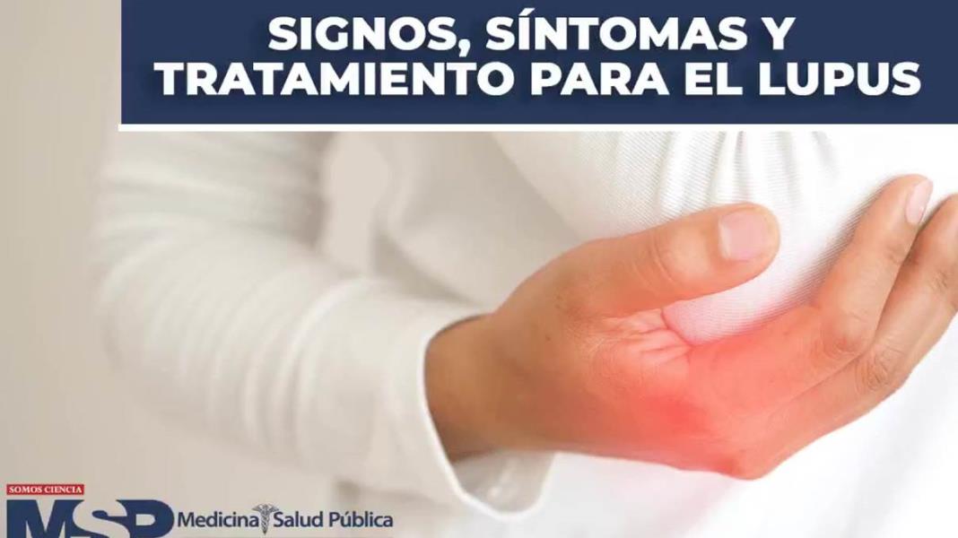 Signos, síntomas y tratamiento para el lupus
