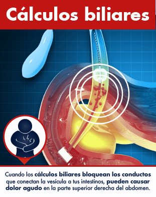 Cálculos biliares