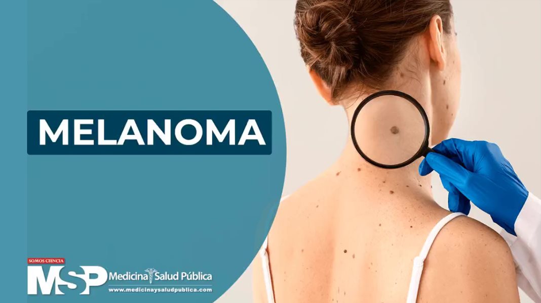 Melanoma