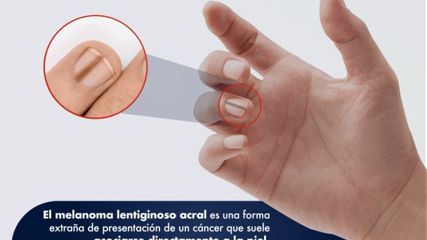 Melanoma en uñas Melanoma en uñas
