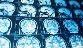 Avances clínicos de la Esclerosis Múltiple