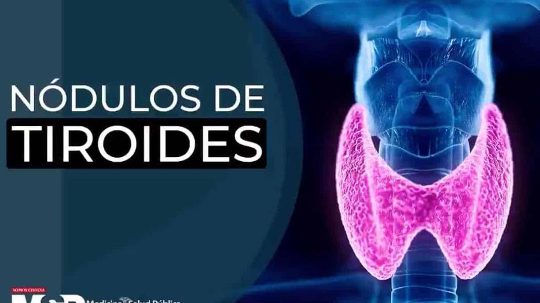 Expertos hablan sobre los Nódulos en la Tiroides