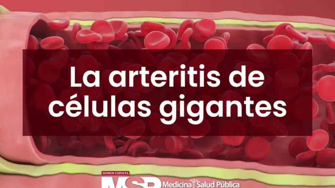 La arteritis de células gigantes