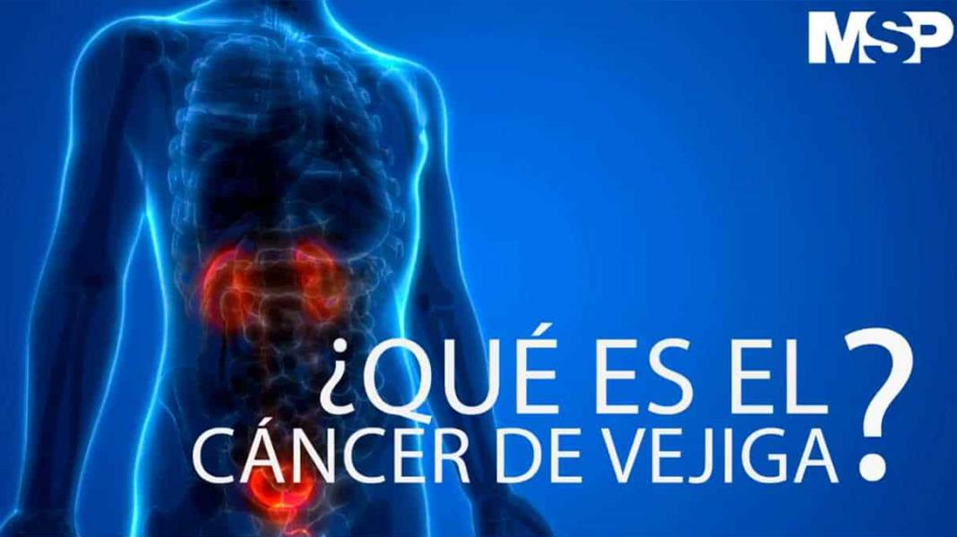 Cáncer de Vejiga