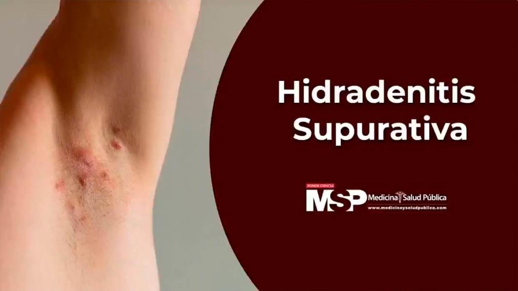 Hidradenitis Supurativa con la Dra. Alma Cruz