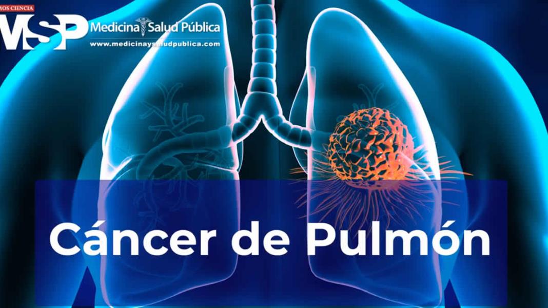 Cáncer de pulmón