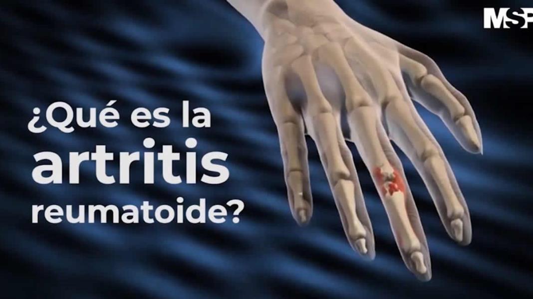 Artritis Reumatoide