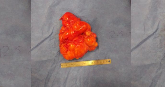 Detectan lipoma en glúteo de paciente puertorriqueña de 15 años